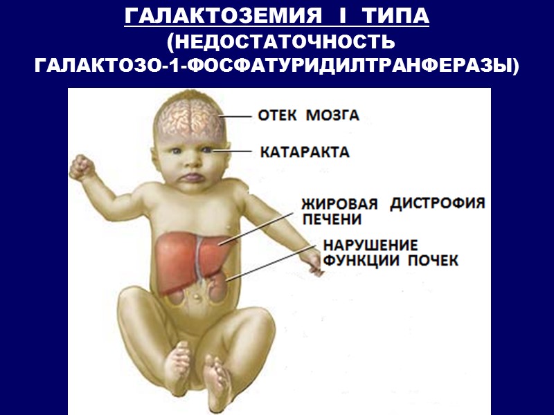 ГАЛАКТОЗЕМИЯ  I  ТИПА  (НЕДОСТАТОЧНОСТЬ ГАЛАКТОЗО-1-ФОСФАТУРИДИЛТРАНФЕРАЗЫ)